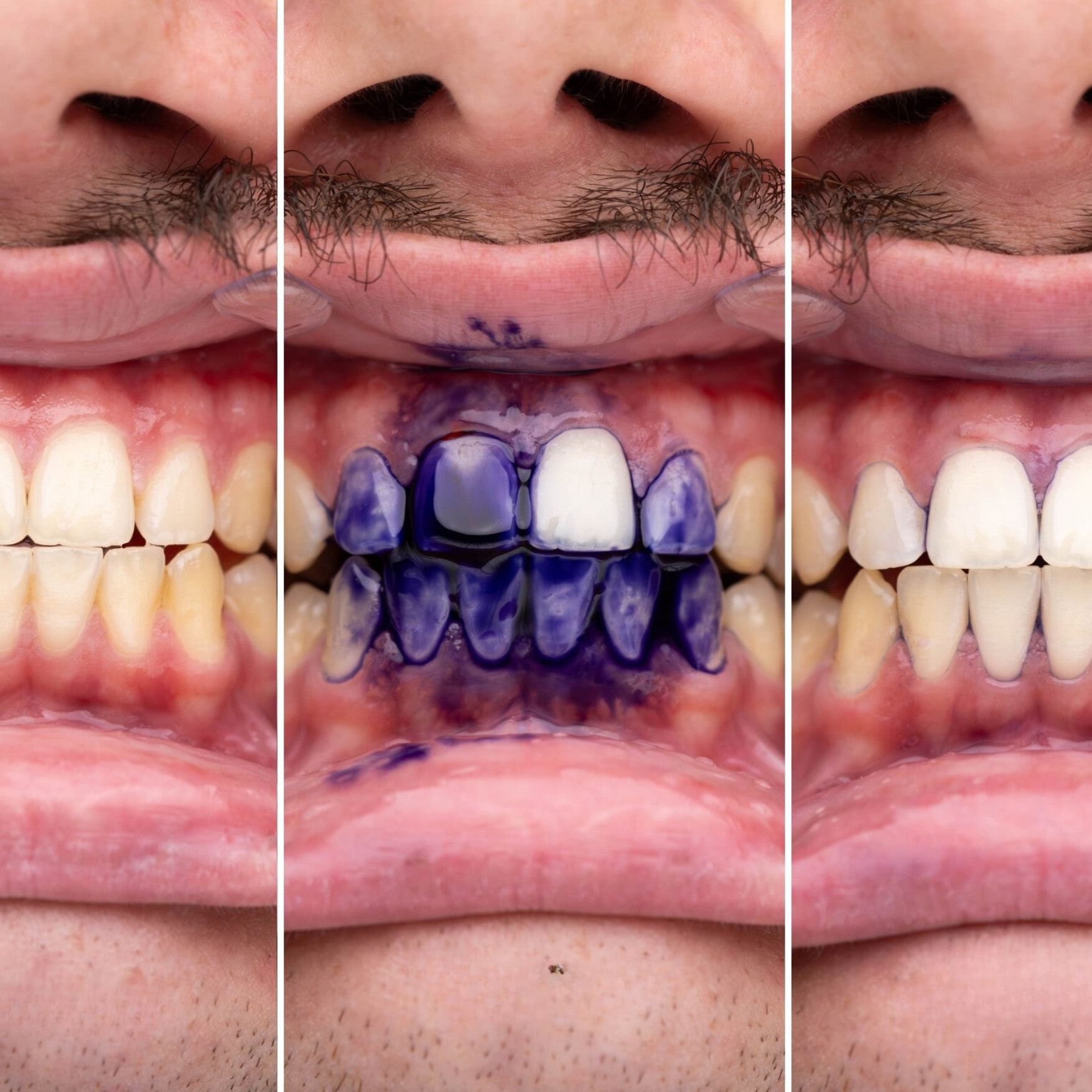 V24™ Momentinis Dantų Balinimo Serumas